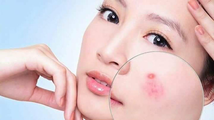 Kem Trị Mụn Trứng Cá Azeloin Zinc Chính Hãng Dưỡng Da Mặt-1