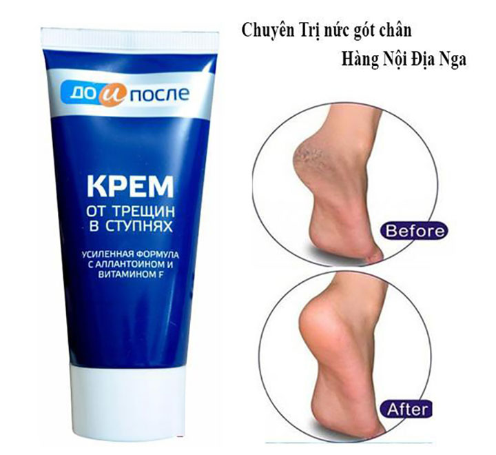 Kem Trị Nứt Gót Chân Kpem Chính Hãng Nga Chăm Sóc Da-1