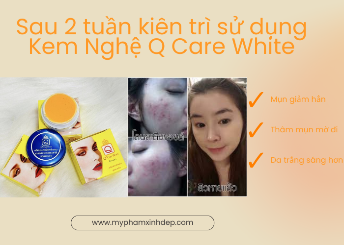 dep-moi-ngay-trai-nghiem-dang-kinh-ngac-voi-kem-nghe-q-care-white-da-sang-min-mun-tham-bien-mat-30