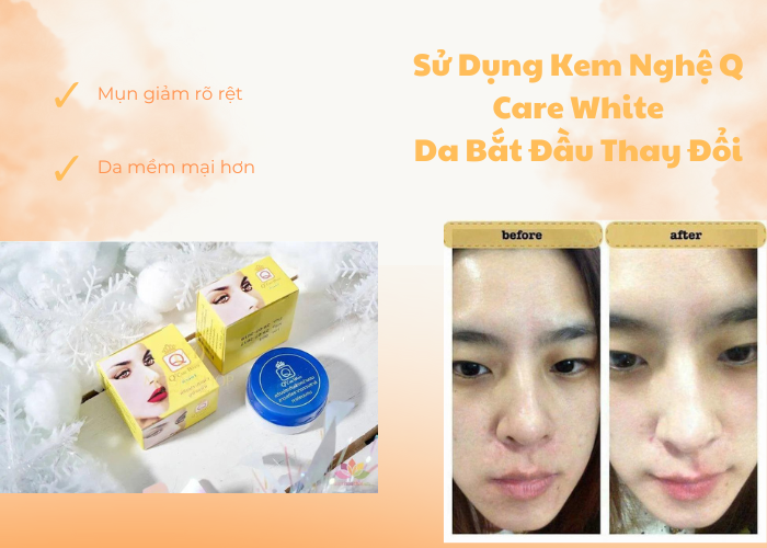 dep-moi-ngay-trai-nghiem-dang-kinh-ngac-voi-kem-nghe-q-care-white-da-sang-min-mun-tham-bien-mat-30